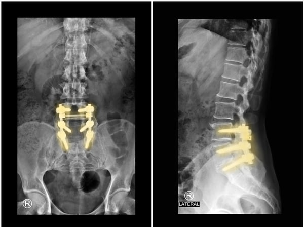 Spinal Medical Implants